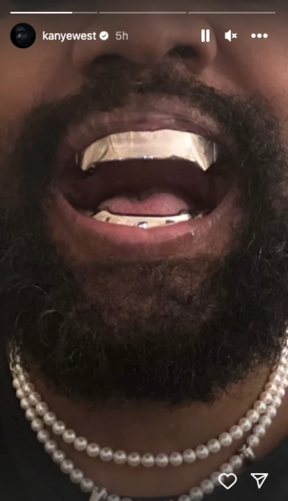 Kanye West New titanium Teeth