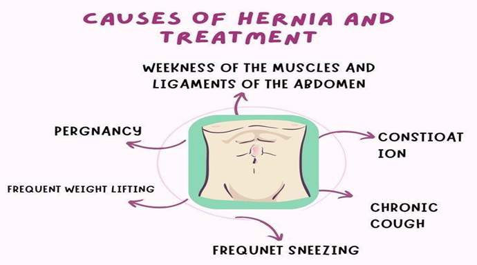 CAN HERNIA BE CURED BY HOMOEOPATHY MEDICINE